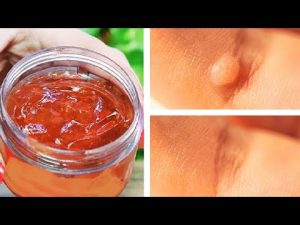 Read more about the article Rub This on Your Wart To Kill the Virus and Remove It Forever