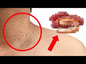 Read more about the article One Common Food That’s Secretly Causing Your Skin Tags